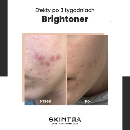 SkinTra - Brightoner - Year-round 9% Acid Tonic - 100ml